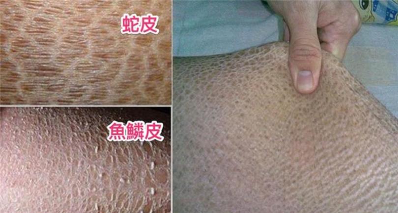 冬天腿上多層「蛇皮」「魚鱗皮」怎麼辦?只要多這一步,包準你三天內水嫩到會反光!就怕你太晚知道。。。。。。趕快收藏吧!