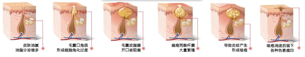 為什麼痘痘反覆難祛?男女有別,避免誤區!清痘+除印