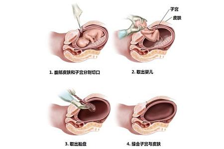 一胎剖，二胎想順，可以嗎？