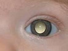 3個月寶寶眼睛如貓眼發光,醫院檢查結果讓一家人痛哭崩潰!