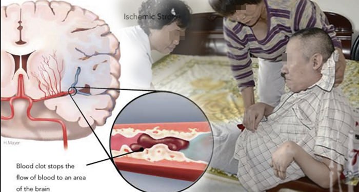 驚!90%的人不知道,長期吃這個水果,才能預防「中風死亡」!轉載一次救人一命!!