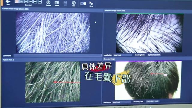 白頭髮越拔越多?你被騙了多少年 。。。
