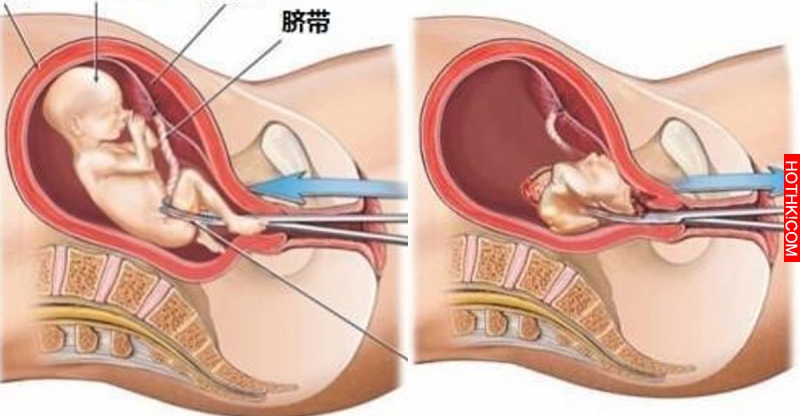 墮胎真的是這樣嗎？看完我終於明白了...這麼多年我都搞錯了！ ...