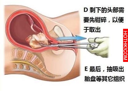 墮胎真的是這樣嗎？看完我終於明白了...這麼多年我都搞錯了！ ...