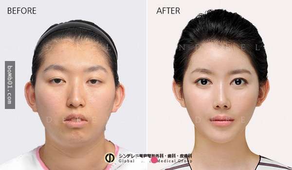 15張「手術前VS手術後」照片，見證了韓國整形界的偉大！