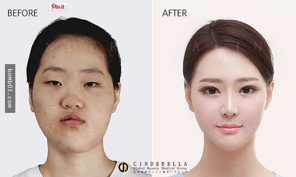 15張「手術前VS手術後」照片，見證了韓國整形界的偉大！