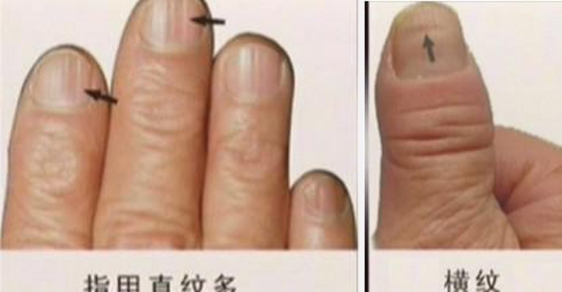 手指告訴你健康狀！原來常出手汗的人竟然會..