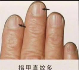 手指告訴你健康狀！原來常出手汗的人竟然會..