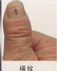 手指告訴你健康狀！原來常出手汗的人竟然會..