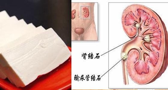 太可怕了!豆腐跟這8種食物一起吃~居然會得腎結石?! 更嚴重竟然還會..一定要分享出去!