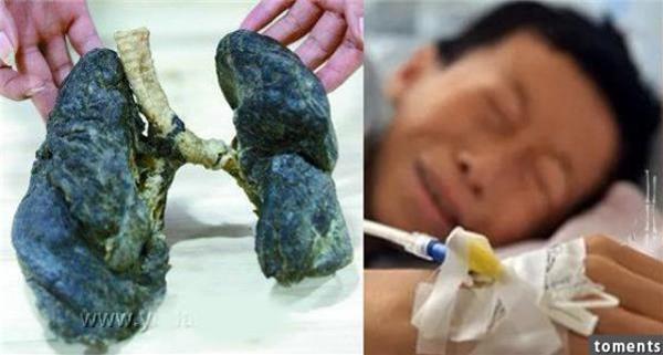 太恐怖了 ! 這個少年才20歲,肺全爛掉!只因為他一直待在... 天啊!超多人天天去!