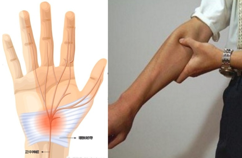 手拇指、食指、中指三指常常會麻，就是中風的危險群！手麻竟然就是『大病』的前兆.