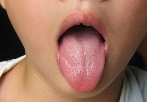 愛吃蝦子居然就得了「舌癌」!只因為在吃蝦時用嘴巴剝殼