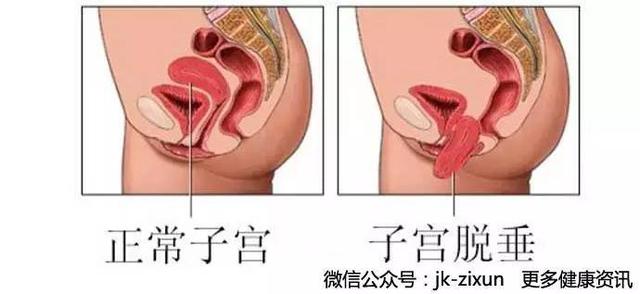 產後休養不當致子宮脫垂？！這到底怎麼回事？