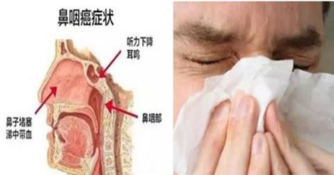 天吶!15歲男孩已是『鼻咽癌晚期』,尤其是喜歡吃『這個』的你要注意了!