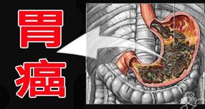 如果你也有這些症狀,請早點去醫院做個胃鏡