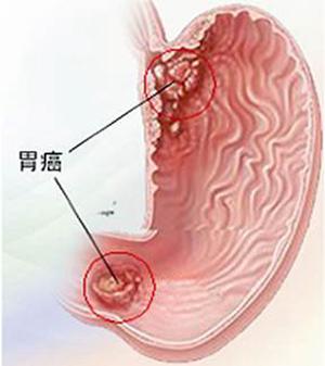 如果你也有這些症狀,請早點去醫院做個胃鏡