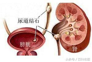 警惕腎結石的早期信號,教你幾招讓結石自己排出來!