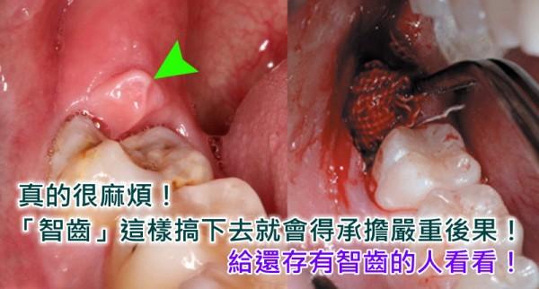 拔智齒的注意事項