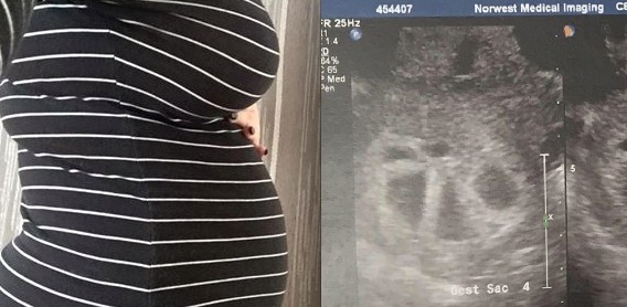 她產檢時才發現懷的不止一個，「寶寶數量」多到數不清，連醫生都嚇傻了！沒想到「超音波」竟照到了..
