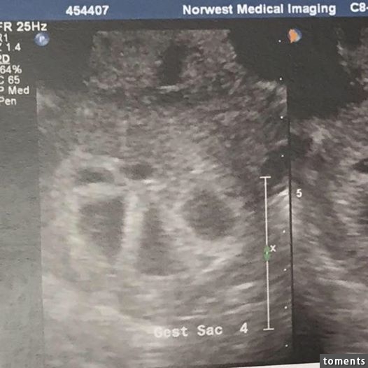 她產檢時才發現懷的不止一個，「寶寶數量」多到數不清，連醫生都嚇傻了！沒想到「超音波」竟照到了..