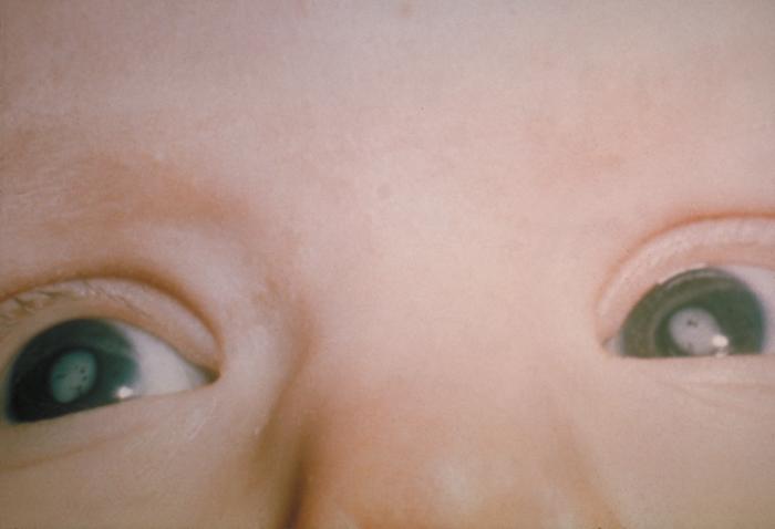 一眼看出寶寶的眼睛疾病
