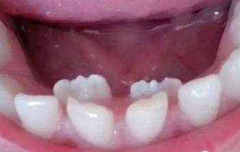 孩子換牙，長出的牙齒很醜、不整齊怎麼辦？