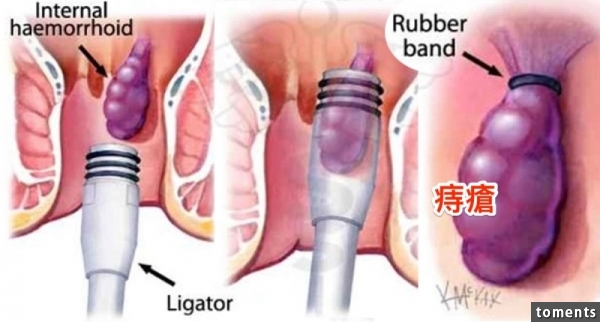 不用再為痔瘡而苦了!!教你"這方法"馬上自然根除,屁屁不再痒痒!只要這樣做...太有效了!