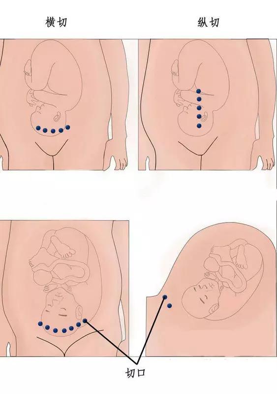 關於剖腹產和順產的12點，是孕媽都必須了解