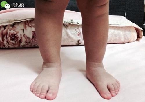 快看看你家寶寶的雙腿，出現這些問題到底該怎麼辦？