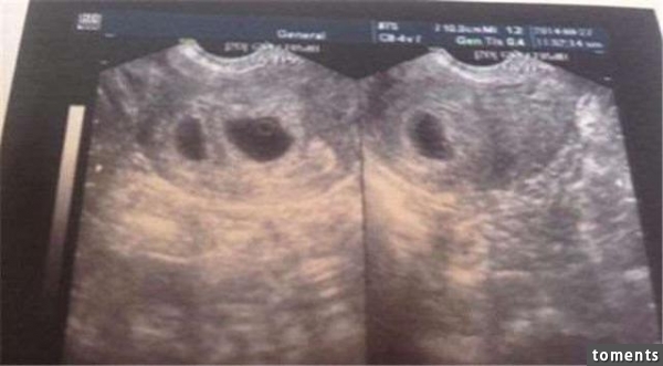 媽媽本來超開心懷雙胞胎，結果40天過後做產檢竟只剩一個！結果醫生表示：「另一個被吃掉了。」當知道真相後。。阿彌陀佛！
