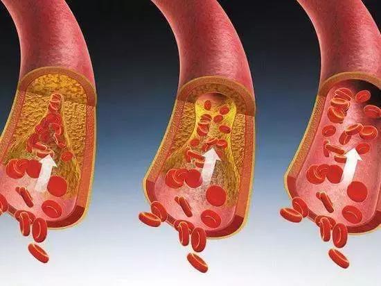 血管堵沒堵，抬腳便知！ 1個動作6種食物讓全身血液暢通