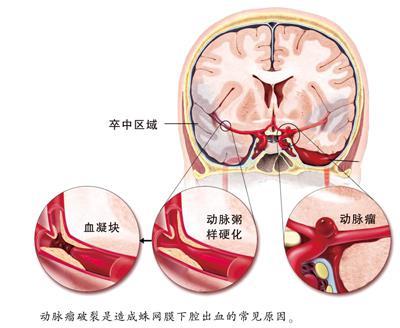 這10個症狀，是猝死前兆