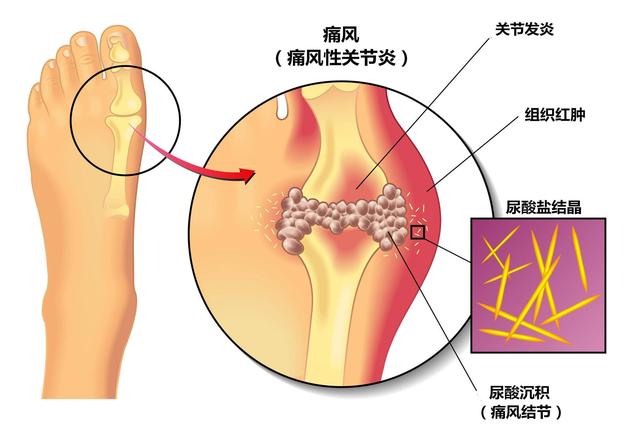 尿酸高,離痛風有多遠? 做好“三多二少一禁”,能降低尿酸!