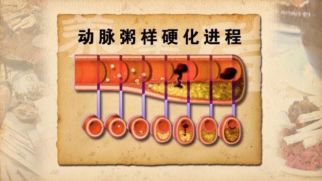 血液垃圾堆積、血液粘稠像漿糊,煮1種水每天喝2次,清血管垃圾