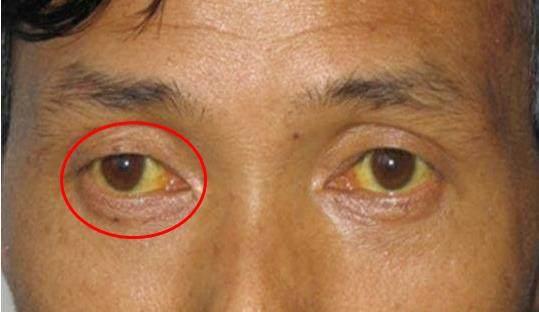 一旦眼睛出現這8種症狀要當心，這可能是大病的徵兆，要及時就醫