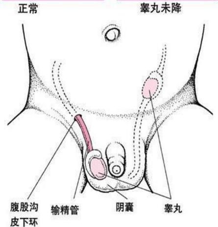 為什麼有些男人只有一個“蛋蛋”? 這是病嗎?