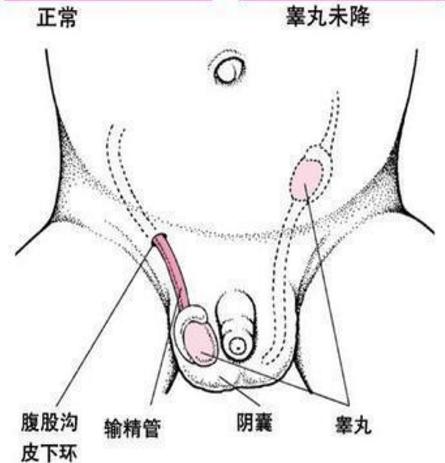 為什麼有些男人只有一個“蛋蛋”？ 這是病嗎？