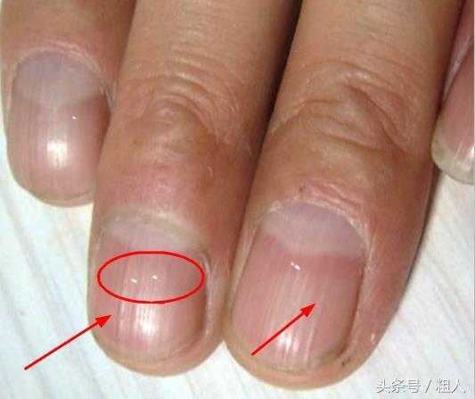 指甲上有豎紋、白點? 這是身體在向你求救,吃這幾樣食物可改善
