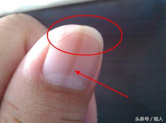 指甲上有豎紋、白點? 這是身體在向你求救,吃這幾樣食物可改善