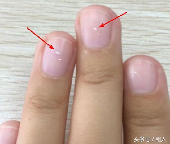 指甲上有豎紋、白點? 這是身體在向你求救,吃這幾樣食物可改善