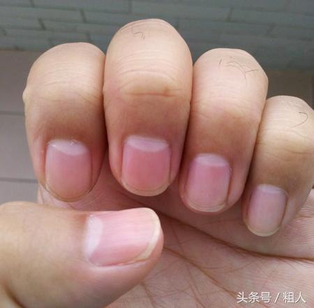 指甲上有豎紋、白點? 這是身體在向你求救,吃這幾樣食物可改善