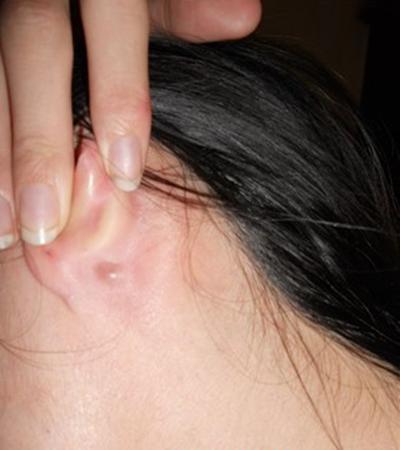 為什麼耳朵裡會長痘？ 疼的時候怎麼辦？