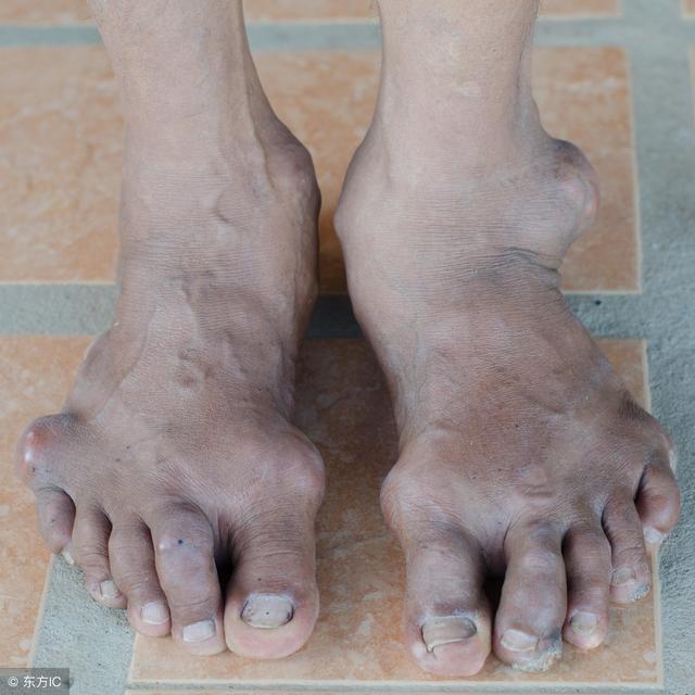 夏季是痛風“高發期”！ 做對5件事，痛風遠離你！