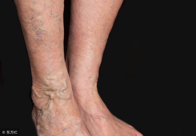 小腿靜脈曲張很危險，這5個方法，可以去掉腿上的“小蚯蚓”！