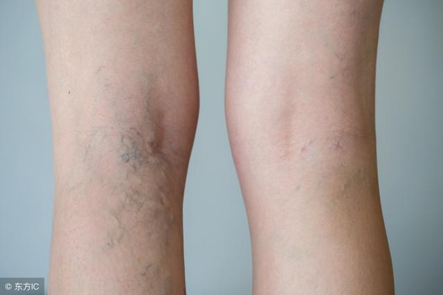 小腿靜脈曲張很危險，這5個方法，可以去掉腿上的“小蚯蚓”！