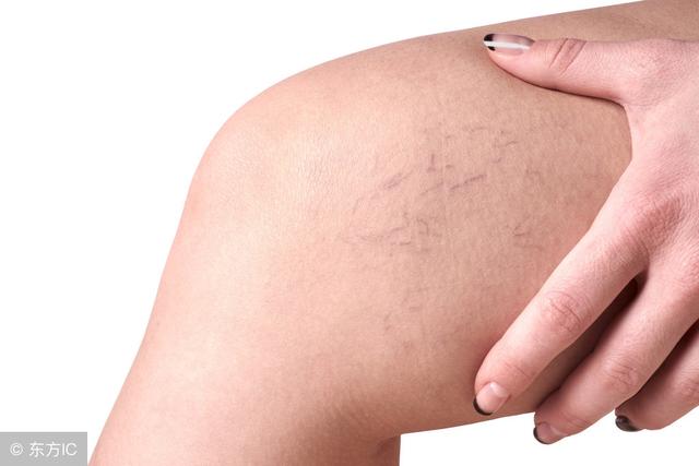 小腿靜脈曲張很危險，這5個方法，可以去掉腿上的“小蚯蚓”！