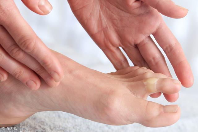 雞眼可能是高跟鞋惹的禍！ 妙用烏梅，巧治雞眼不復發！