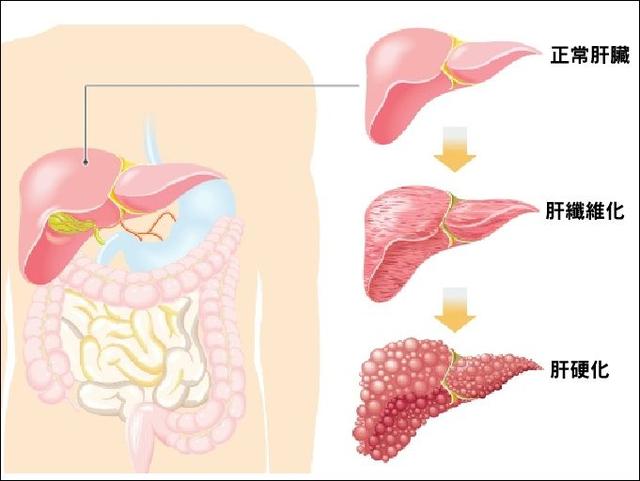 身體出現這10個症狀，可能是肝臟變硬了！