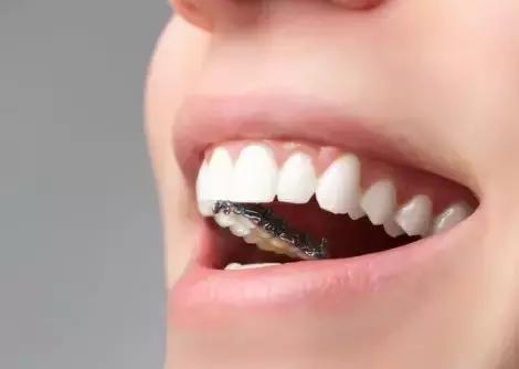 還在猶豫是否整牙，明星們默默變美都在靠它，你想知道的這篇都有